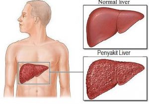 Pengobatan Alami Madu untuk Liver yang Patut Kita Ketahui